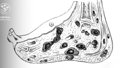 الورم الفطري